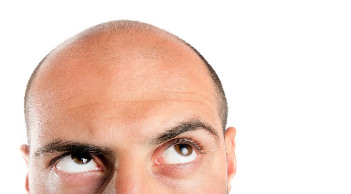 درمان ریزش مو با ترمیم مو امکانپذیر است